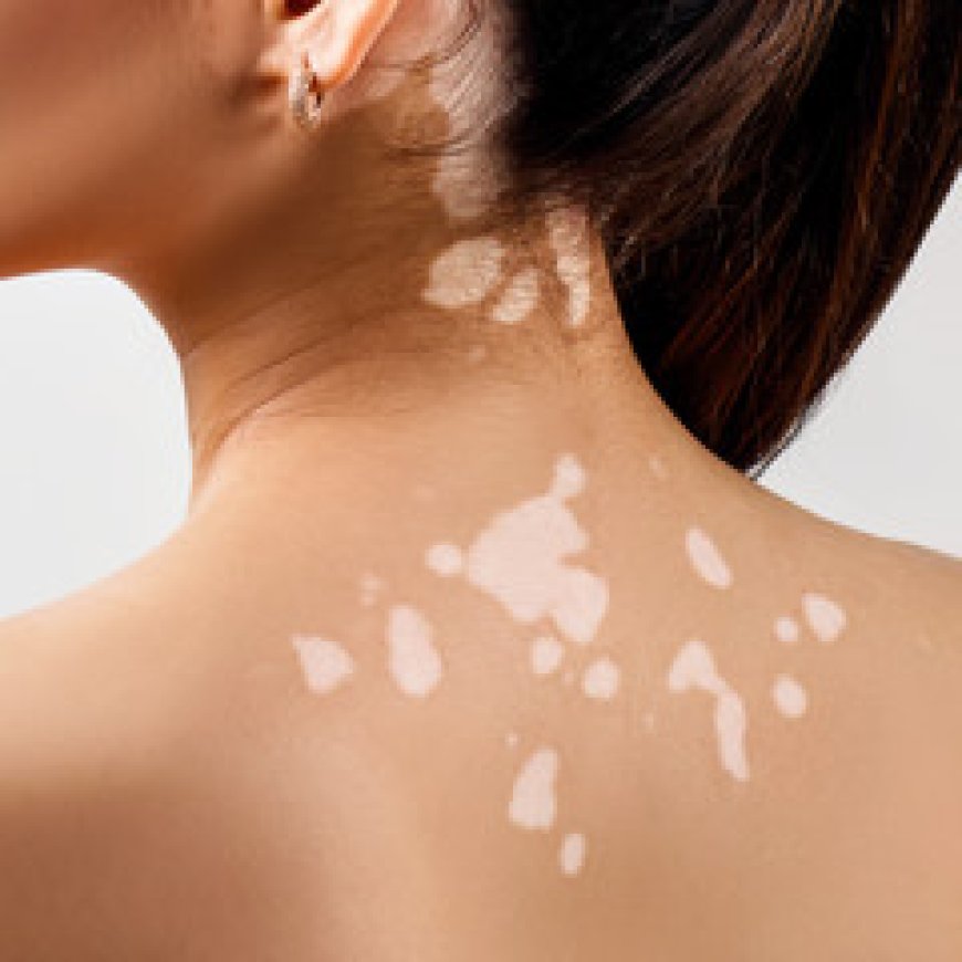 Micropigmentation for Vitiligo Near Me: An Innovative Solution for Skin Pigmentation