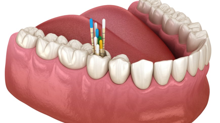 Gutta Percha In Focus: Empowering Dentists With Optimal Root Canal Filling Solutions