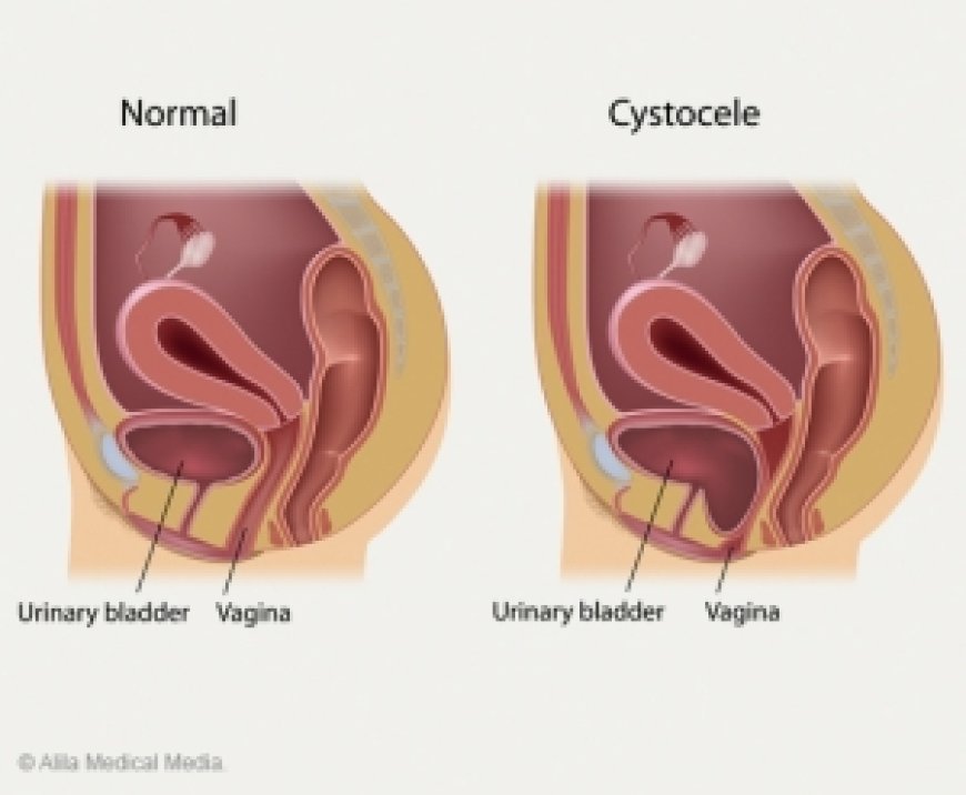 Understanding Cystocele Surgery Success Rates: A Comprehensive Overview