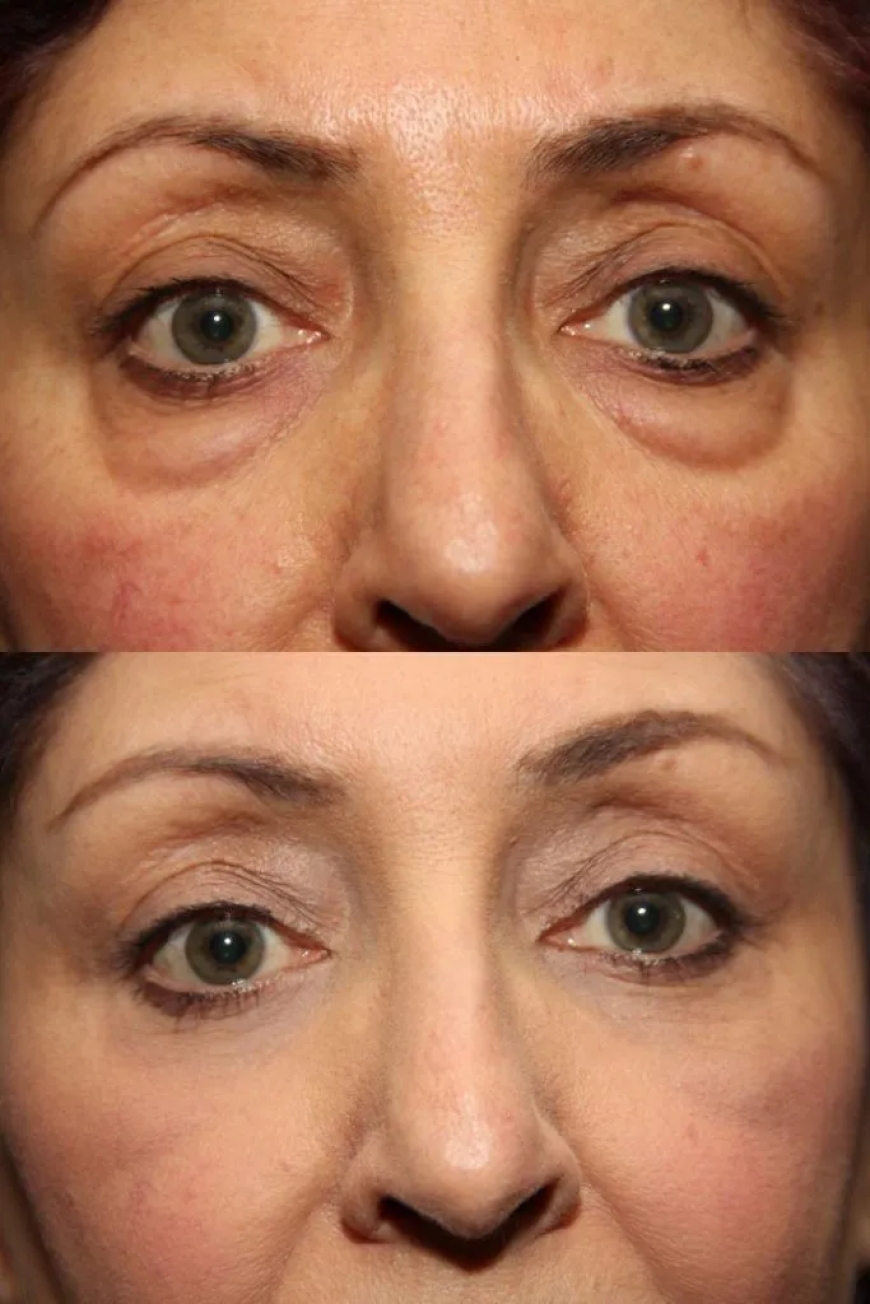 Deciding the Right Time for Blepharoplasty: A Comprehensive Guide