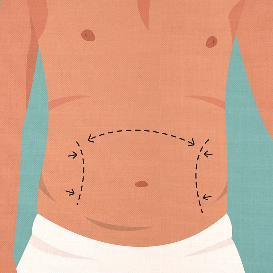 How to Prepare for a Tummy Tuck: Tips for Optimal Results and Recovery