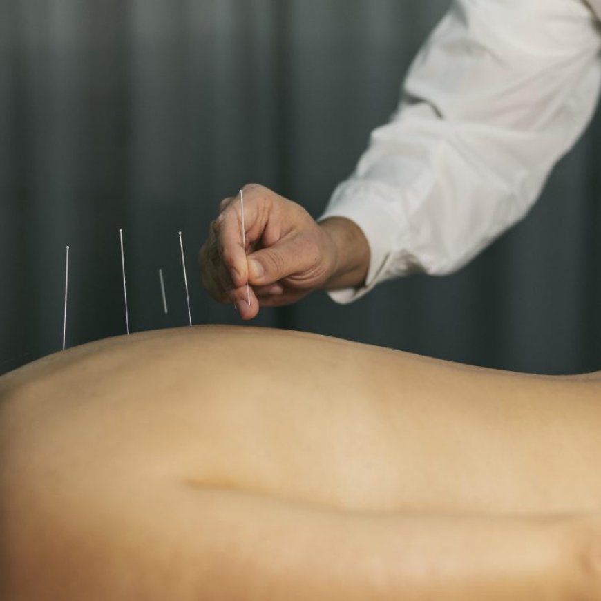 Ancient Needles, Modern Magic: Recharge with Cutting-Edge Acupuncture in Bowen Hills