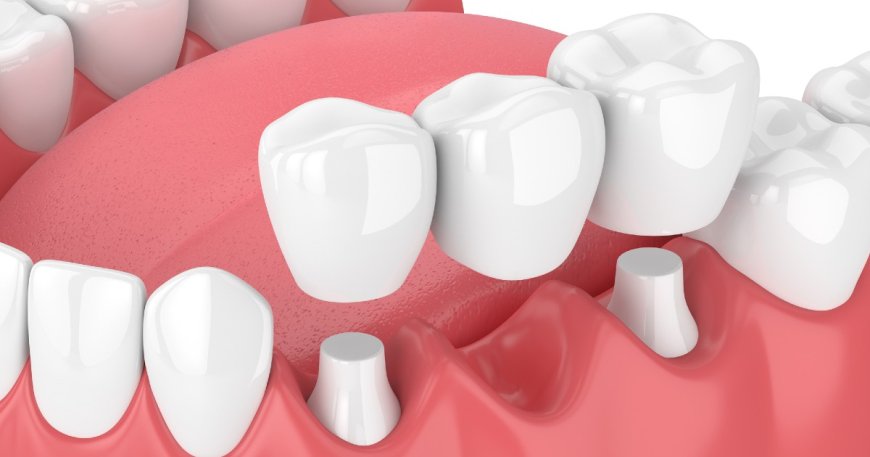 Discover Comprehensive Dental Bridge Services: Enhancing Your Smile