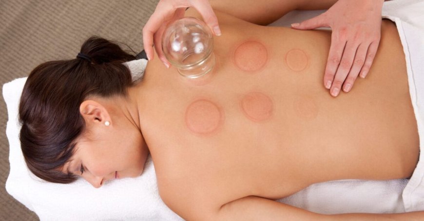 Cupping Therapy for Stress and Anxiety: A Holistic Approach