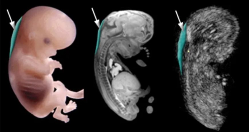 Nuchal Translucency