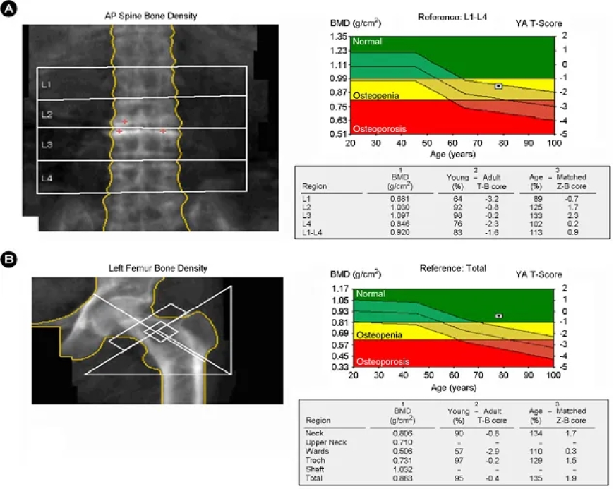 BMD- Bone Mineral Densitometry