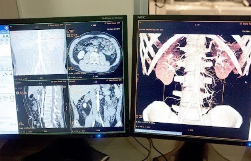 CT Coronary Angiography