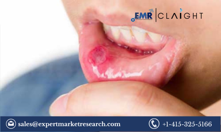 Mouth Ulcer Treatment Market: Insights, Dynamics, and Key Players 2024-2032