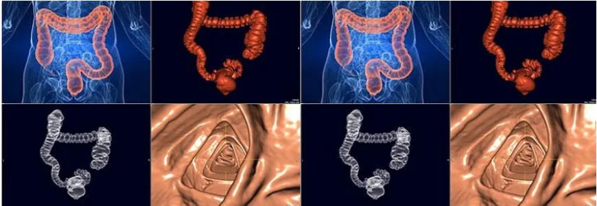 CT Virtual Colonography