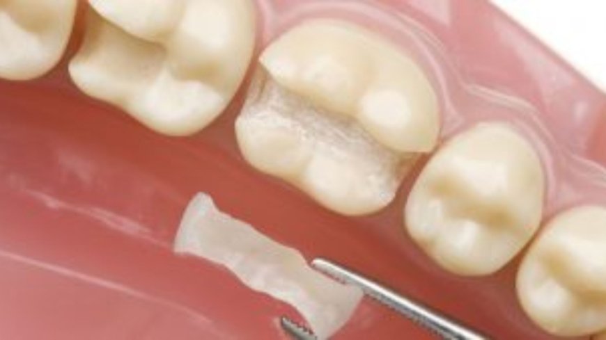 Why Teeth Cap Services Are Essential for Chipped and Broken Teeth