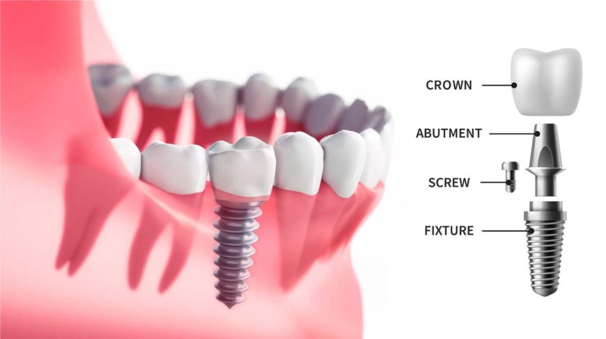 Rebuilding Smiles: The Role of Dental Implants in Auburn, Liverpool, Bankstown, and Fairfield