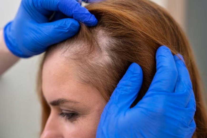 Say Farewell to Thinning Hair: Stem Cell Therapy in Delhi, India | Elantiscare