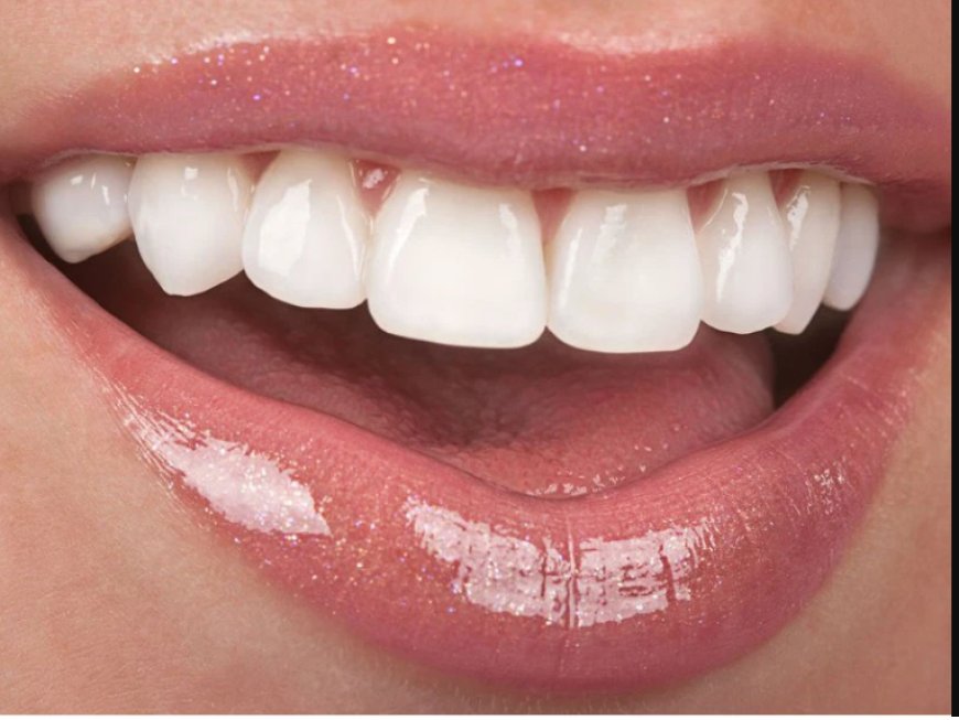 What Are The Benefits Of Porcelain Veneers In Dentistry?