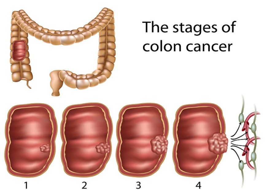 How is Colorectal Cancer Diagnosed and Staged?