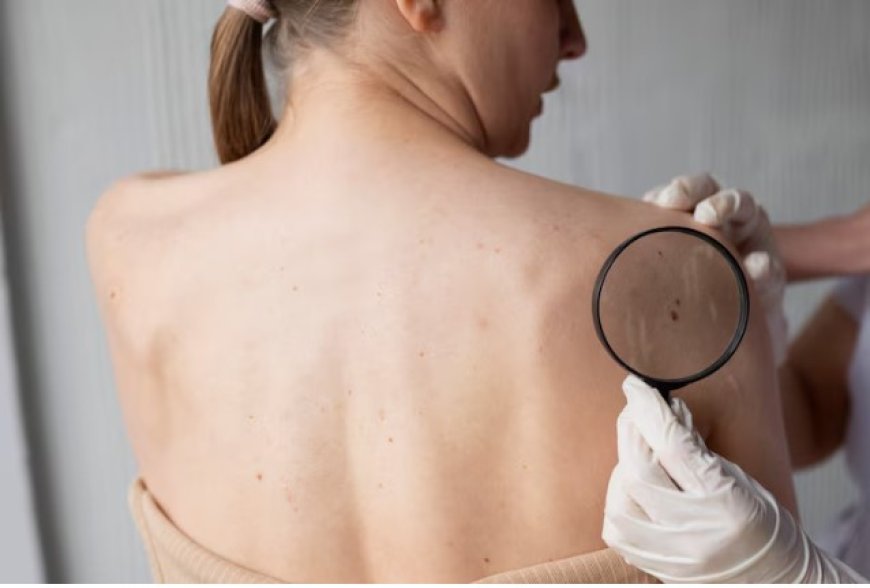 Skin Tag Removal: What You Need to Know Before Getting Started