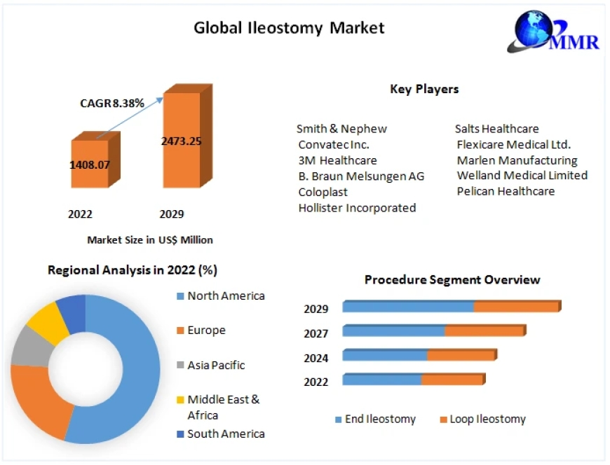 Ileostomy Market Industry Trends, Segmentation, Business Opportunities & Forecast To 2029