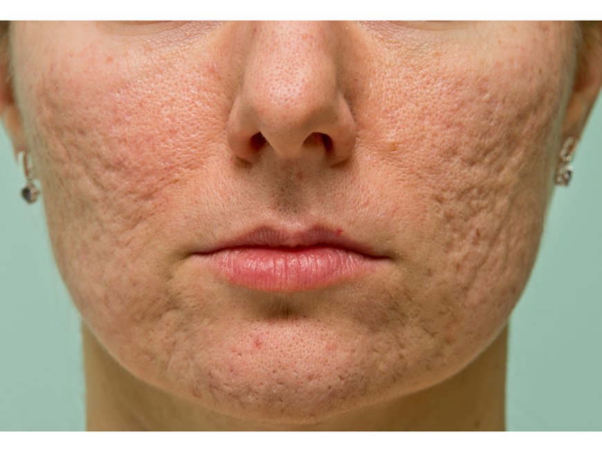 Preventing Acne Scars with the Expertise of Top Dermatologists