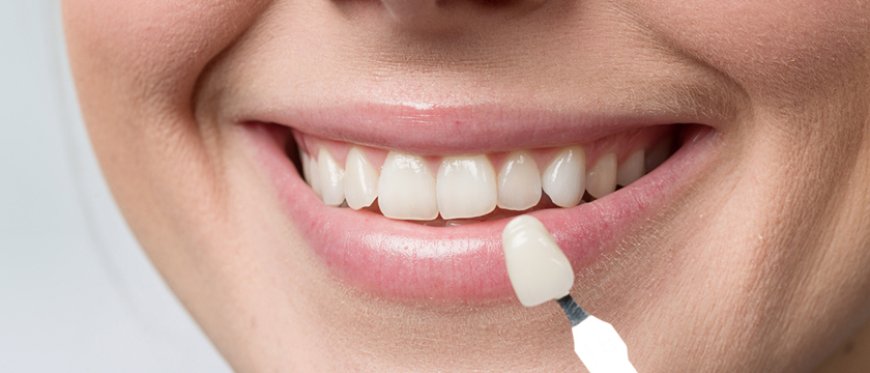 Dental Veneers: Transform Your Teeth and Your Confidence