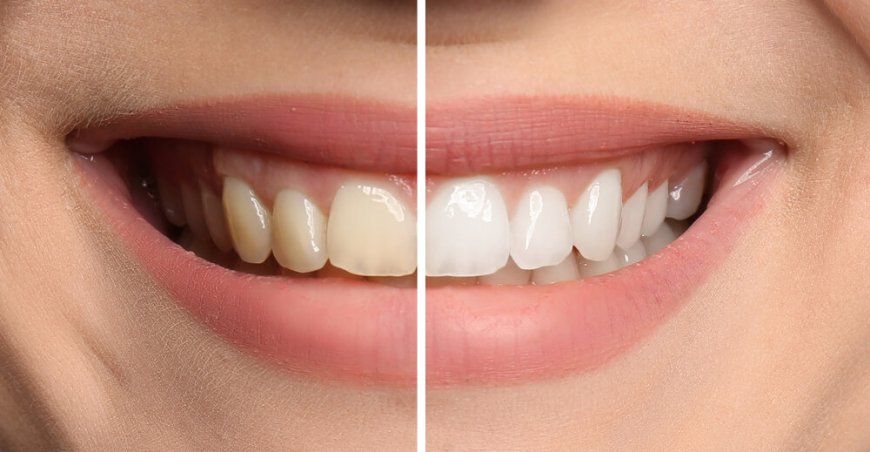 Your Destination for Teeth Whitening Excellence in Canada
