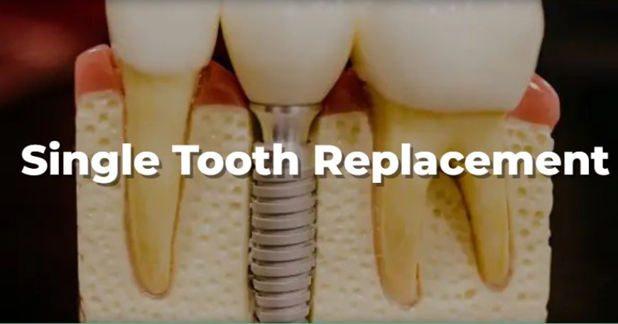Reclaim Your Smile: Exploring Tooth Replacement Options in Houston