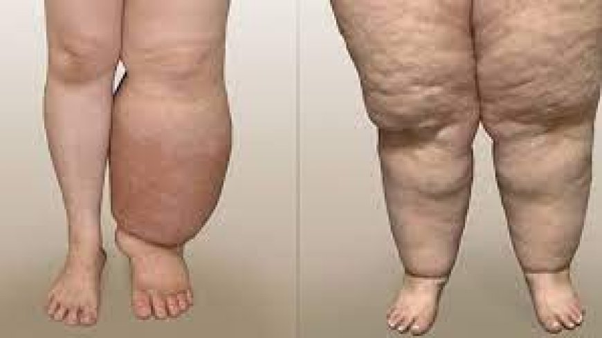 Best Lipedema Surgeon Dubai