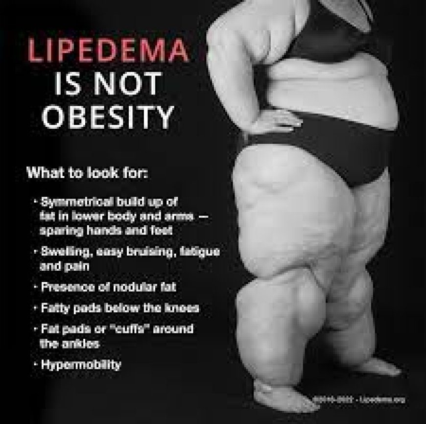 Lipedema Disease Treatment Dubai