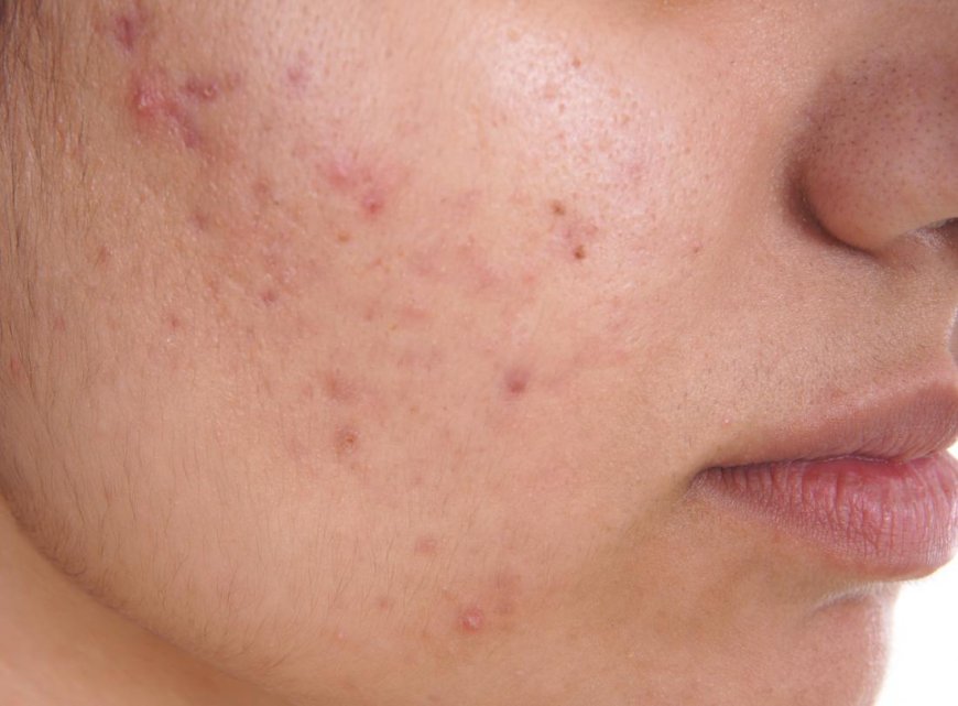 Punch Excision Treatment: A Breakthrough for Acne Scarring