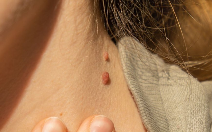 Is Skin Tag Removal Quick and Safe?