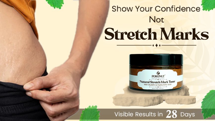 Can You Really Say Goodbye to Stretch Marks Forever?