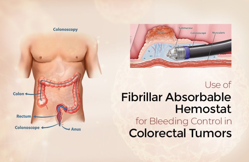 Fibrillar Absorbable Hemostat: A Promising Aid for Bleeding Control in Colorectal Tumors