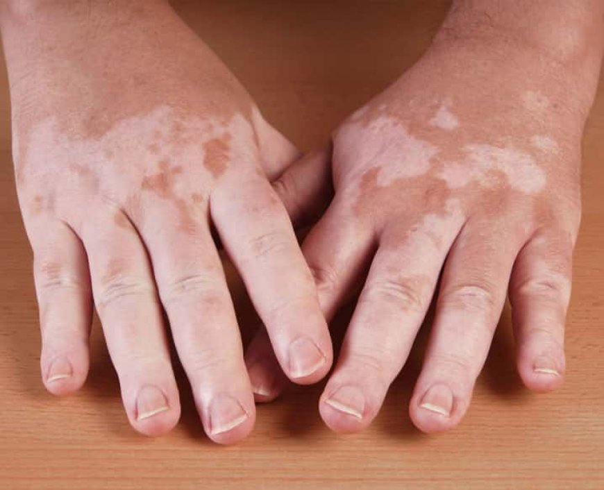 Dermatologist Recommended Tips To Prevent Vitiligo From Worsening