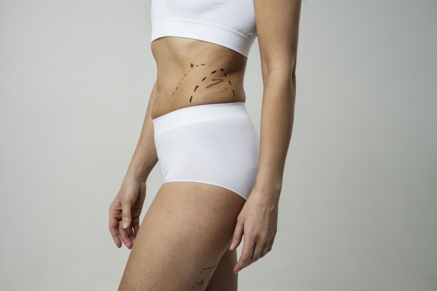 Does Liposuction in Dubai Permanently Remove Fat