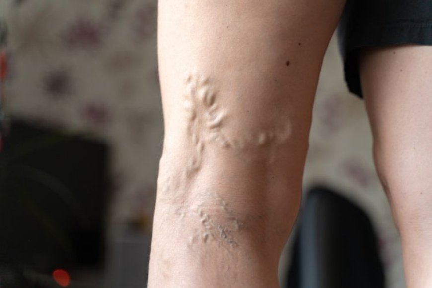 Unveiling the Hidden Risks of Downplaying Varicose Veins