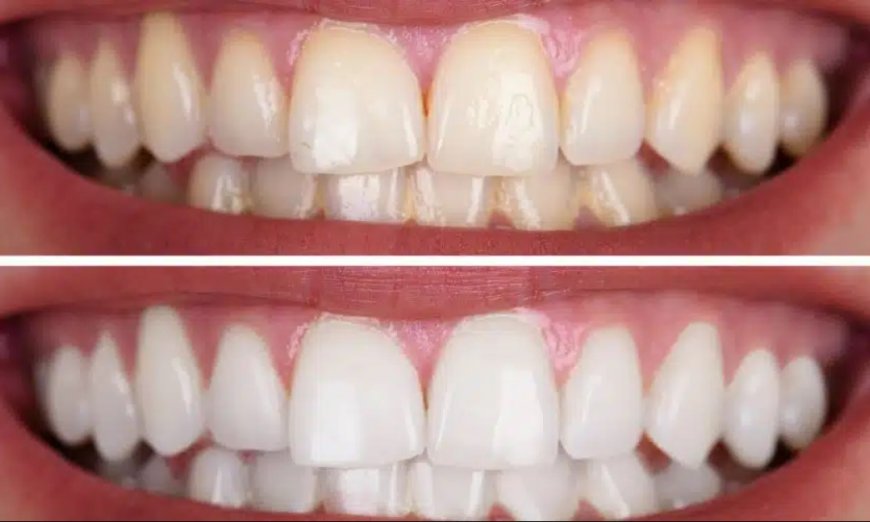 Improve Your Smile with Professional Houston teeth whitening