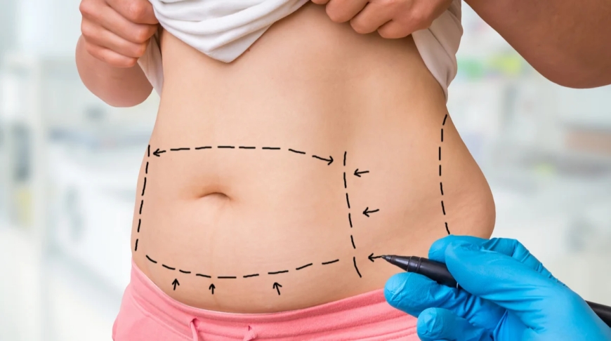 Unveil The Risks And Realities of Liposuction in Dubai