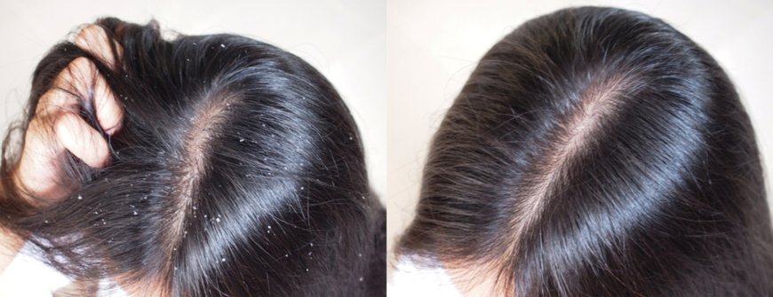 Hair Dandruff Treatment