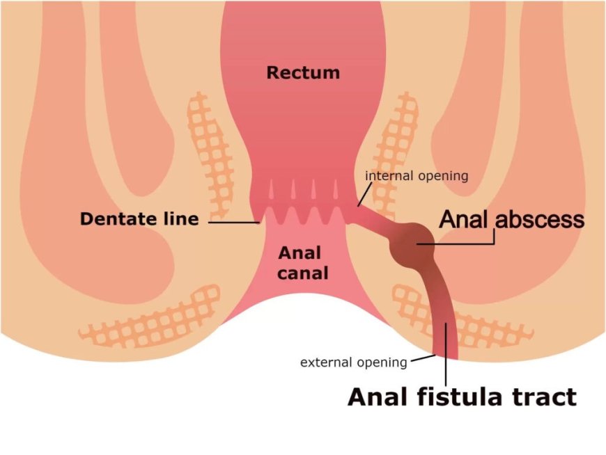 Fistula Homeopathic Treatment: Integrating Homeopathy and Natural Remedies