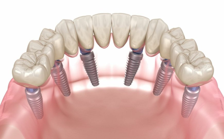 Considering Dental Implants in New York? Should Know About the Process