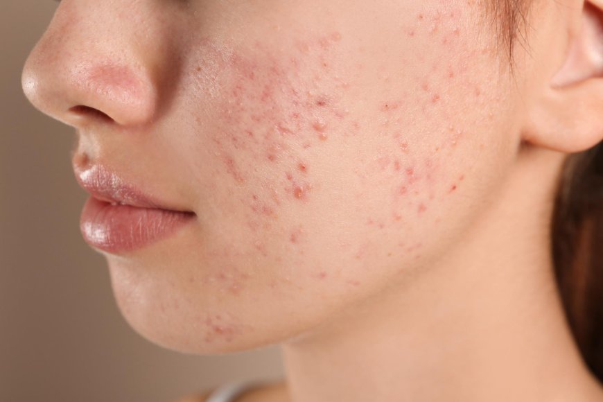 What Causes a Rash Like Acne on the Face?