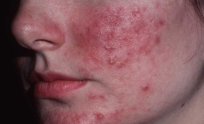 Is Rosacea Causing You Red, Irritated Face?