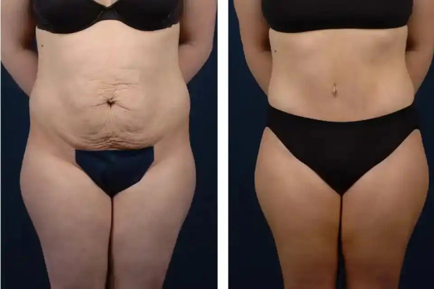 Tummy Tuck in Dubai: Combining Procedures for Comprehensive Results