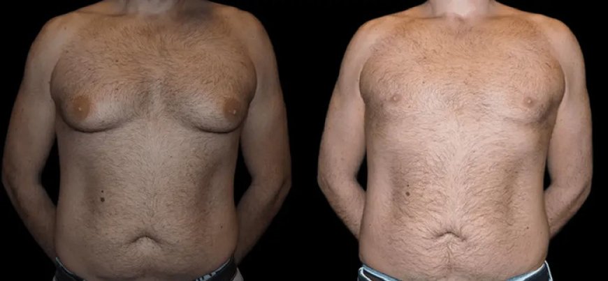 Long-Term Results of Male Breast Reduction Surgery: Maintaining Your New Look