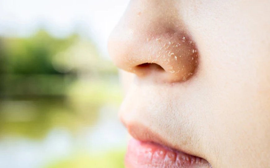 How to Get Rid of Dry Skin Around the Nose and Seborrheic Dermatitis