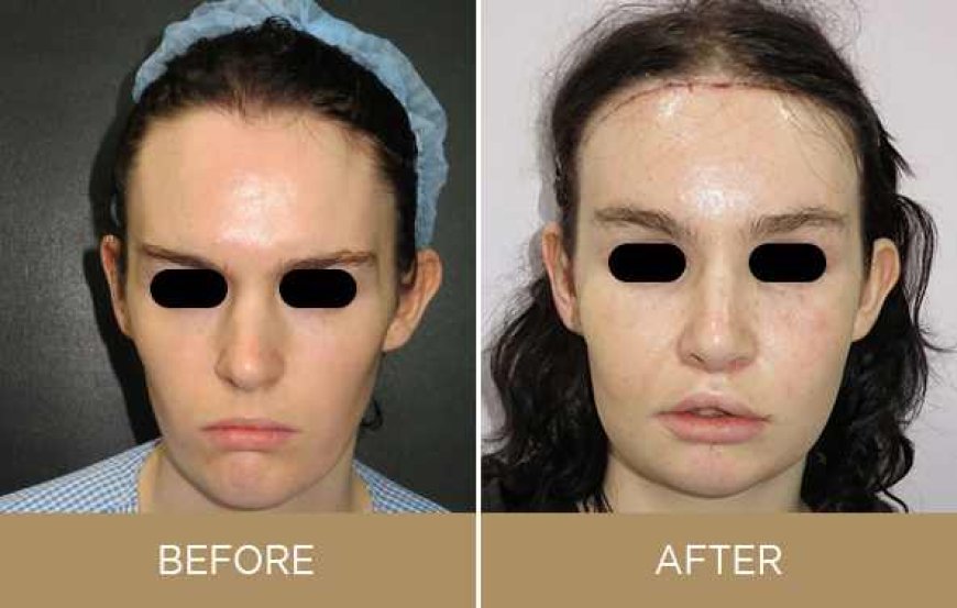 Why is Cheek Augmentation Needed in Facial Feminization?