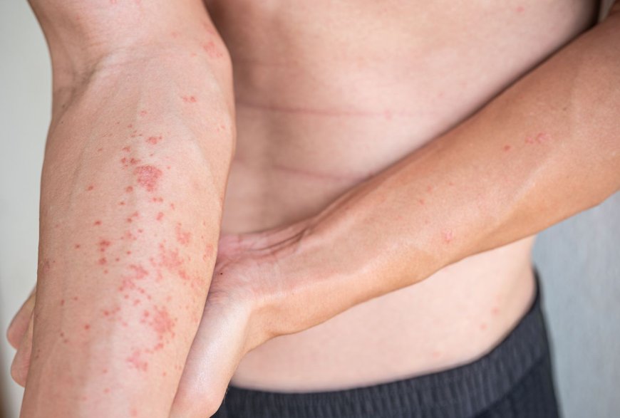 How to Get Rid of Atopic Dermatitis?