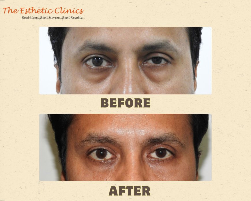 Eyelid Perfection: The Power of Blepharoplasty Surgery