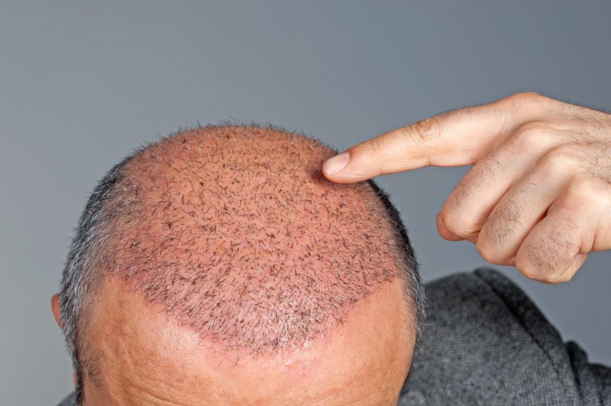 Transform Your Look: Achieve Full, Natural Hair with Advanced Hair Transplant Techniques